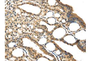 The image on the left is immunohistochemistry of paraffin-embedded Human thyroid cancer tissue using ABIN7191125(ISM2 Antibody) at dilution 1/45, on the right is treated with synthetic peptide. (Isthmin 2 anticorps)