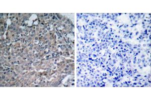 Peptide - +Immunohistochemical analysis of paraffin-embedded human breast carcinoma tissue using FAK (Ab-925) antibody (#B7083). (FAK anticorps  (Tyr925))