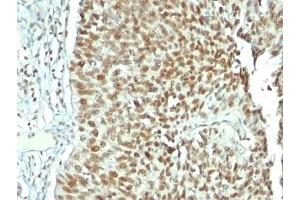 Formalin-fixed, paraffin-embedded human bladder carcinoma stained with Nucleolin antibody. (Nucleolin anticorps)
