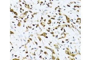 Immunohistochemistry of paraffin-embedded Human gastric cancer using ITGB3BP Polyclonal Antibody at dilution of 1:100 (40x lens).