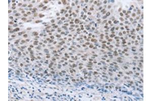The image on the left is immunohistochemistry of paraffin-embedded Human liver cancer tissue using ABIN7191633(NEUROG2 Antibody) at dilution 1/15, on the right is treated with synthetic peptide. (Neurogenin 2 anticorps)