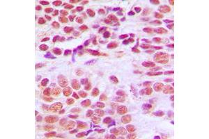 Immunohistochemical analysis of Histone Deacetylase 1 staining in human breast cancer formalin fixed paraffin embedded tissue section. (HDAC1 anticorps  (C-Term))