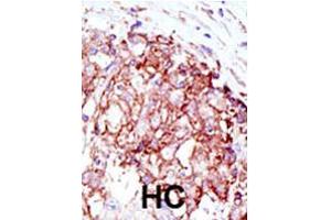 Formalin-fixed and paraffin-embedded human hepatocellular carcinoma tissue reacted with MIB1 polyclonal antibody  , which was peroxidase-conjugated to the secondary antibody, followed by AEC staining. (MIB1 anticorps  (N-Term))