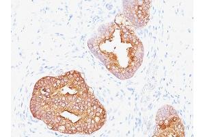 Formalin-fixed, paraffin-embedded human Prostate Carcinoma stained with Prostate Specific Antigen Mouse Monoclonal Antibody (1A7). (Prostate Specific Antigen anticorps)