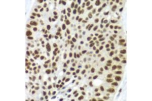 Immunohistochemistry of paraffin-embedded human lung cancer using SF3B2 antibody.