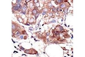IHC analysis of FFPE human breast carcinoma tissue stained with the MUSK antibody (MUSK anticorps  (AA 829-859))