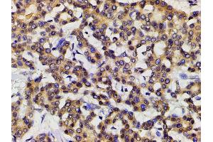 ABIN6277691 at 1/200 staining human liver cancer tissue sections by IHC-P. (Ephrin B2 anticorps  (C-Term))