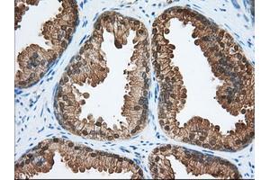 Immunohistochemical staining of paraffin-embedded Adenocarcinoma of Human colon tissue using anti-ACAT2 mouse monoclonal antibody. (ACAT2 anticorps)