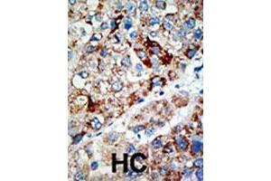 Formalin-fixed and paraffin-embedded human hepatocellular carcinoma tissue reacted with USP21 polyclonal antibody , which was peroxidase-conjugated to the secondary antibody, followed by AEC staining. (USP21 anticorps  (N-Term))