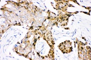 Anti- Ubiquitin Picoband antibody, IHC(P) IHC(P): Human Mammary Cancer Tissue