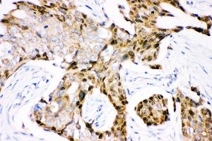 Anti- Ubiquitin Picoband antibody, IHC(P) IHC(P): Human Mammary Cancer Tissue (Ubiquitin B anticorps  (AA 77-152))