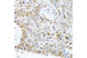 Immunohistochemistry of paraffin-embedded human lung cancer using LRPPRC antibody.