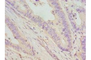Immunohistochemistry of paraffin-embedded human colon cancer using ABIN7149695 at dilution of 1:100 (DMP1 anticorps  (AA 254-513))