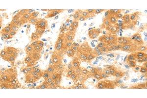 Immunohistochemistry of paraffin-embedded Human liver cancer using MAP2K6 Polyclonal Antibody at dilution of 1:30 (MAP2K6 anticorps)