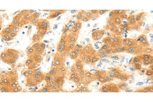 Immunohistochemistry of paraffin-embedded Human liver cancer using MAP2K6 Polyclonal Antibody at dilution of 1:30 (MAP2K6 anticorps)