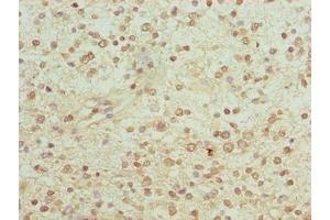 Immunohistochemistry of paraffin-embedded human glioma using ABIN7153904 at dilution of 1:100