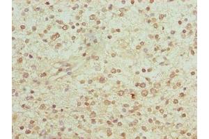 Immunohistochemistry of paraffin-embedded human glioma using ABIN7153904 at dilution of 1:100 (PGM2L1 anticorps  (AA 101-400))
