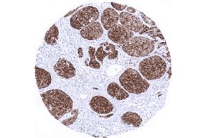 Skin Malignant melanoma with strong Melan A positivity in all tumor cells