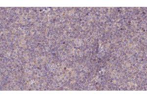 ABIN6273145 at 1/100 staining Human lymph cancer tissue by IHC-P. (NDUFS7 anticorps  (Internal Region))
