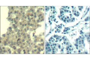 Immunohistochemical analysis of paraffin-embedded human breast carcinoma tissue using Her3/ErbB3 (Ab-1328) Antibody (E021510). (ERBB3 anticorps)