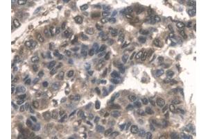 Detection of ALDOA in Human Liver cancer Tissue using Polyclonal Antibody to Aldolase A, Fructose Bisphosphate (ALDOA)