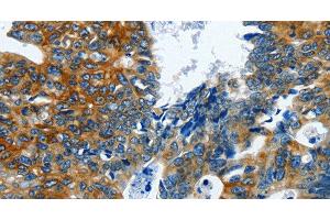 Immunohistochemistry of paraffin-embedded Human colon cancer using BPIFB3 Polyclonal Antibody at dilution of 1:120 (BPIFB3 anticorps)