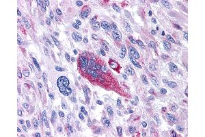 Anti-TACR1 / NK1R antibody IHC of human Brain, Glioblastoma.