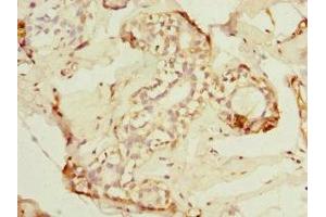 Immunohistochemistry of paraffin-embedded human breast cancer using ABIN7143282 at dilution of 1:100 (ADAD1 anticorps  (AA 1-280))