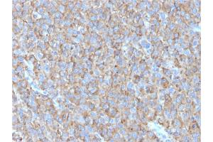 Formalin-fixed, paraffin-embedded human Melanoma stained with CD63 Mouse Monoclonal Antibody (LAMP3/2790) (CD63 anticorps  (AA 100-197))
