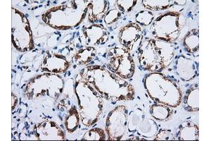 Immunohistochemical staining of paraffin-embedded Carcinoma of Human thyroid tissue using anti-TTC32 mouse monoclonal antibody. (TTC32 anticorps)