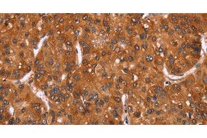 Immunohistochemistry of paraffin-embedded Human liver cancer tissue using HRK Polyclonal Antibody at dilution 1:40 (HRK anticorps)