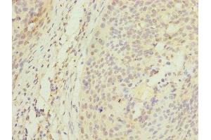 Immunohistochemistry of paraffin-embedded human cervical cancer using ABIN7150355 at dilution of 1:100