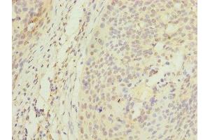 Immunohistochemistry of paraffin-embedded human cervical cancer using ABIN7150355 at dilution of 1:100 (APEX1 anticorps  (AA 32-318))
