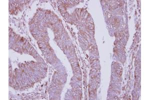 IHC-P Image Immunohistochemical analysis of paraffin-embedded human colon carcinoma, using DPY19L4, antibody at 1:250 dilution. (DPY19L4 anticorps  (C-Term))