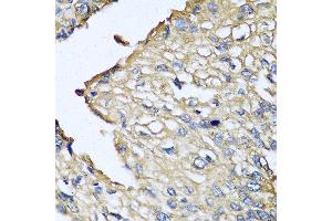 Immunohistochemistry of paraffin-embedded human prostate cancer using ASIP antibody at dilution of 1:100 (40x lens). (ASIP anticorps)