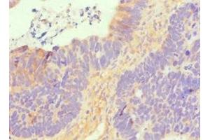 Immunohistochemistry of paraffin-embedded human ovarian cancer using ABIN7170114 at dilution of 1:100 (GLUT1 anticorps  (AA 210-310))
