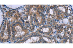 Immunohistochemistry of paraffin-embedded Human thyroid cancer tissue using PLIN1 Polyclonal Antibody at dilution 1:30 (PLIN1 anticorps)