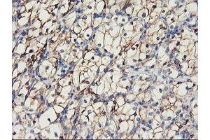 Immunohistochemical staining of paraffin-embedded Carcinoma of Human kidney tissue using anti-CDH2 mouse monoclonal antibody. (N-Cadherin anticorps)