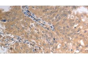 Immunohistochemistry of paraffin-embedded Human ovarian cancer using SLC1A4 Polyclonal Antibody at dilution of 1:70