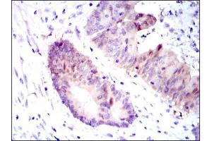 Immunohistochemical analysis of paraffin-embedded colon cancer tissues using ASS1 mouse mAb with DAB staining.