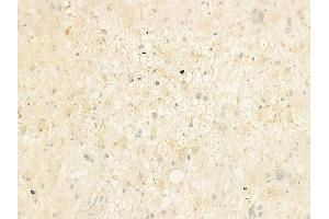 ABIN6264637 and ABIN6273153 at 1/100 staining human astrocytoma by IHC-P. (RAP1B anticorps  (C-Term))
