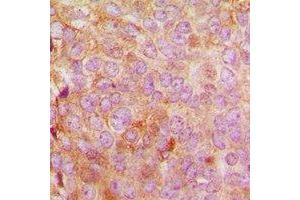 Immunohistochemical analysis of MRPL48 staining in human breast cancer formalin fixed paraffin embedded tissue section.