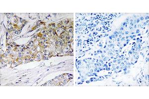 Peptide - +Immunohistochemistry analysis of paraffin-embedded human breast carcinoma tissue using DHRS11 antibody. (DHRS11 anticorps)