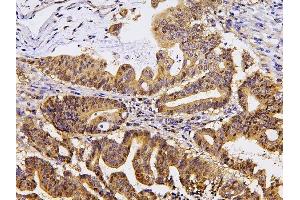 IHC analysis of PPA1 using anti-PPA1 antibody (ABIN6719527). (Pyrophosphatase (Inorganic) 1 (PPA1) (AA 7-236) anticorps)