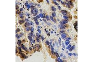 Immunohistochemical analysis of CD29 staining in human lung cancer formalin fixed paraffin embedded tissue section.