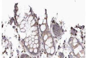 ABIN6267667 at 1/200 staining human colon cancer tissue sections by IHC-P. (CDC37 anticorps  (pSer13))