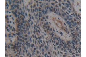 Detection of UBE1L in Human Skin cancer Tissue using Polyclonal Antibody to Ubiquitin Activating Enzyme E1 Like Protein (UBE1L) (UBA7 anticorps  (AA 429-488))