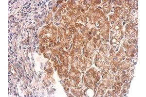 IHC-P Image Cyclophilin 40 antibody detects PPID protein at cytosol on human hepatoma by immunohistochemical analysis.