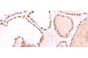 Immunohistochemistry of paraffin-embedded Human thyroid cancer tissue using RUVBL1 Polyclonal Antibody at dilution of 1:85(x200) (RUVBL1 anticorps)