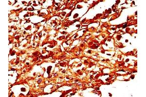 IHC image of ABIN7173988 diluted at 1:300 and staining in paraffin-embedded human melanoma performed on a Leica BondTM system. (TYR anticorps  (AA 19-377))